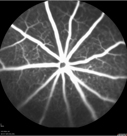 Fluorescein Angiography Image