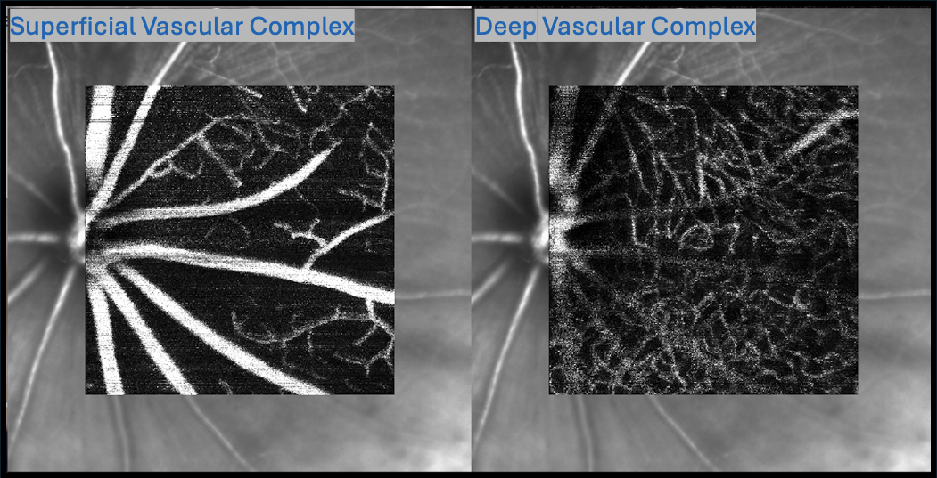 Angiography image